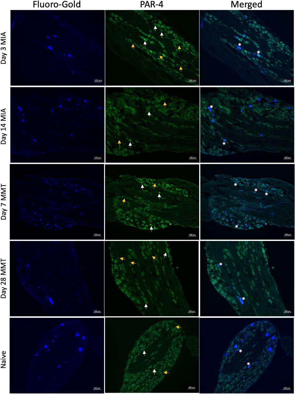 Fig.2 PAR4 expression in joint DRG neurons. (OA Literature)