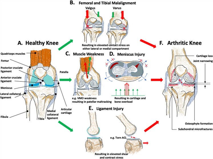 Biomechanical factors leading to osteoarthritis (OA). (OA Literature)
