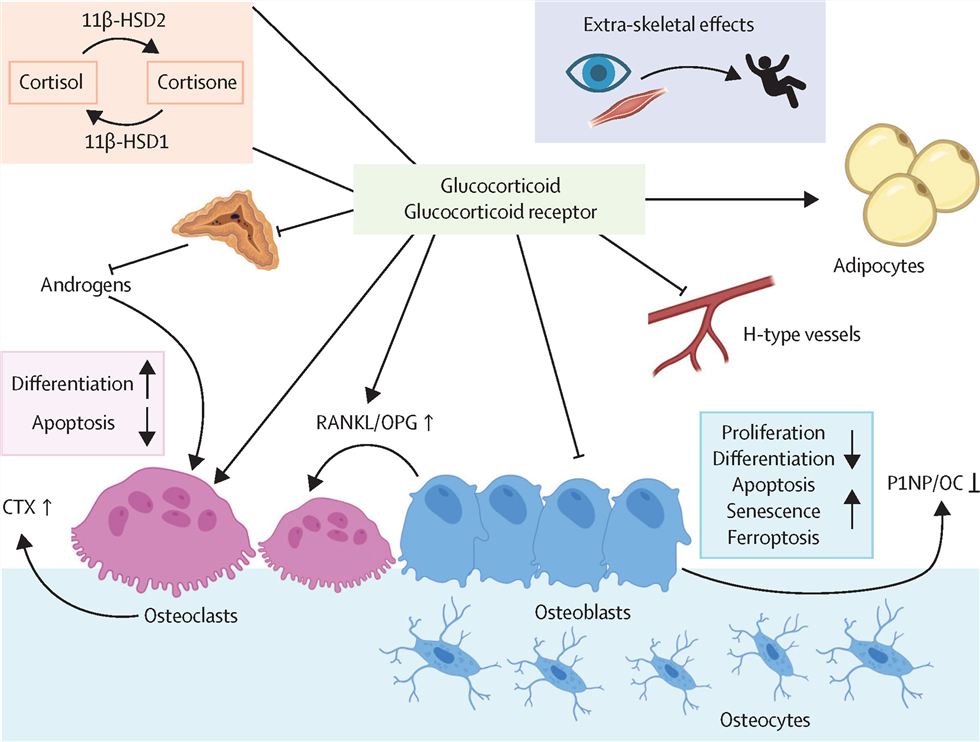 Fig.1 Direct effects of glucocorticoids on bone. (OA Literature)