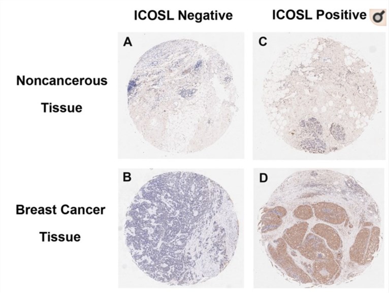 Images of breast cancer immunostaining for ICOSL in cancerous and noncancerous tissues.