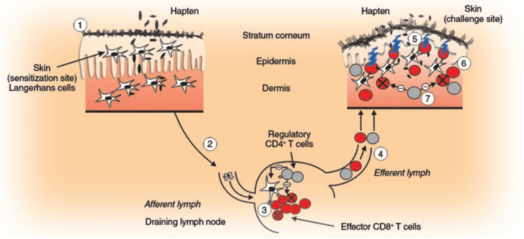 Pathophysiology of allergic contact dermatitis.