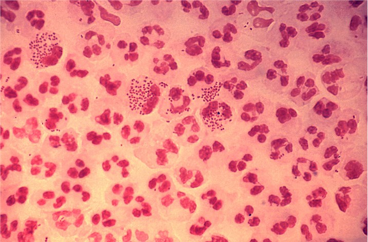 Gram-stain of gonococcal urethritis.