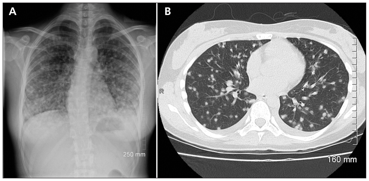 (A) Chest radiograph and (B) computed tomographic scan of a 21-year-old woman with a three-week history of shortness of breath and dry cough following a crop-planting trip to El Salvador. Both images show symmetrically distributed nodules consistent with acute histoplasmosis.