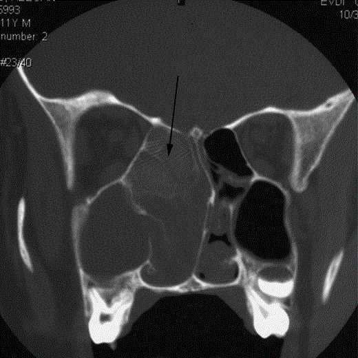 Sinus CT (bone window) of an AFS patient. Allergic mucin (arrow).