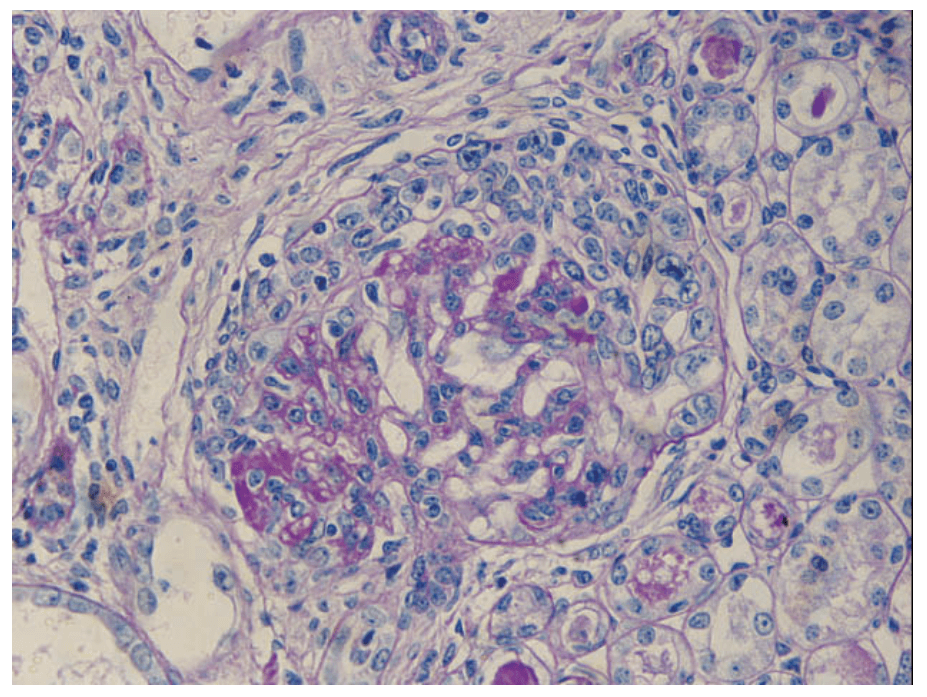 Anti-Glomerular Basement Membrane (GBM) Nephritis Model