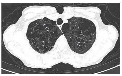 HRCT scan revealing paraseptal emphysema, cavities and destruction of the adjacent parenchyma, predominantly in the upper lobes of the lungs.