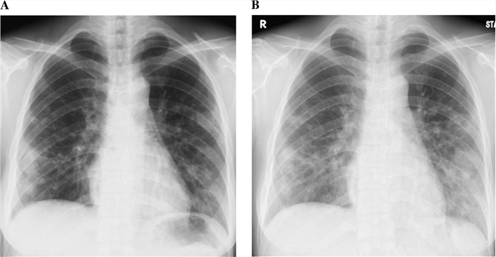 Chest radiography shows enlargement of the lung nodules in coccidioidomycosis.