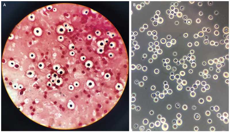 Cryptococcus Neoformans.