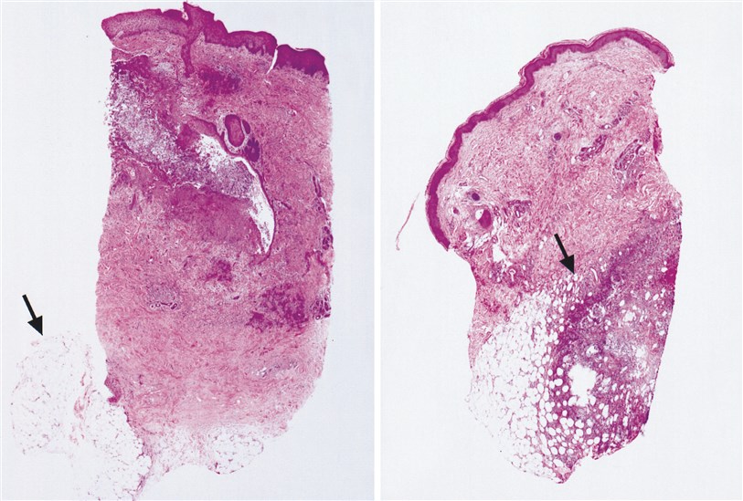 In cases of primary cutaneous aspergillosis (left), inflammation is either solely superficial with sparing of the subcutaneous fat (arrow), as in this case, or superficial and deep. In contrast, the epicenter of inflammation in secondary cutaneous aspergillosis (right) tends to be solely deep dermal or subcutaneous (arrow).