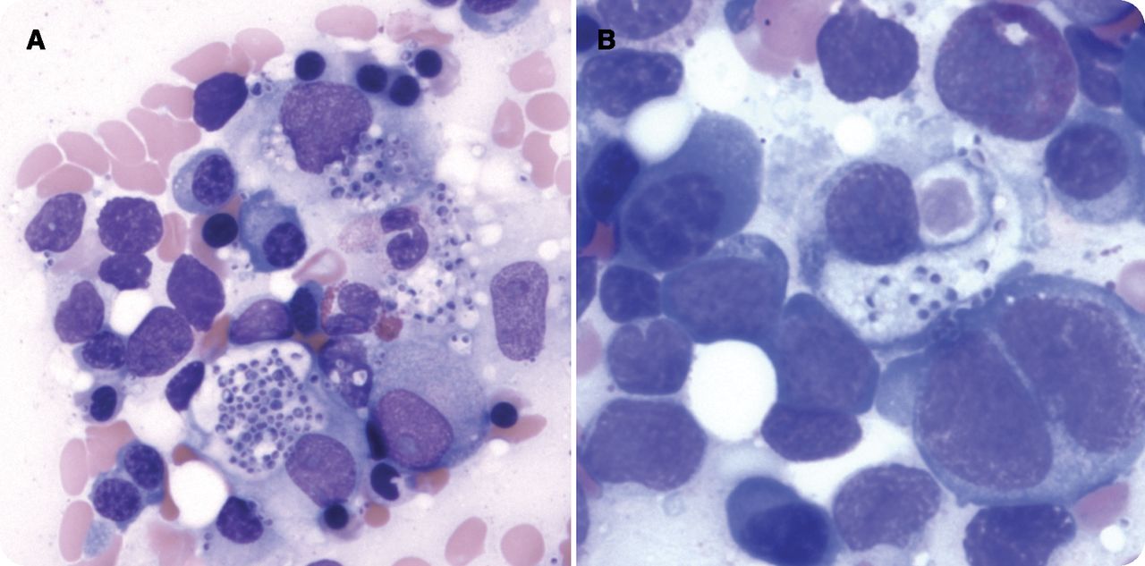 Prominent clusters of Histoplasma capsulatum are seen disseminated throughout the marrow aspirate (panel A). Serologic testing for Histoplasma antigen was positive. Hemophagocytosis is seen (panel B), in which a histiocyte is engulfing a red blood cell and several Histoplasma organisms.