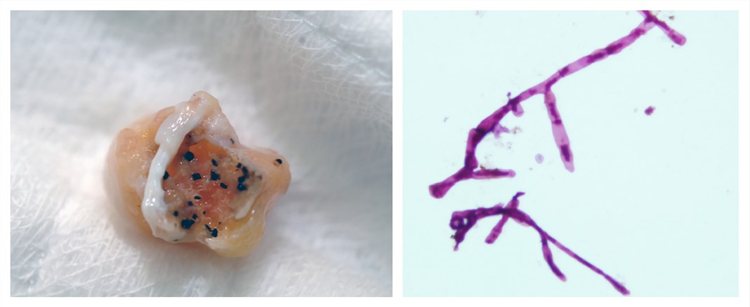 Photography of surgical biopsy showing a well-encapsulated eumycetoma lesion with numerous black grains (left). KOH wet mount direct microscopic examination of M. mycetomatis grains showing its hyphal structure (right).