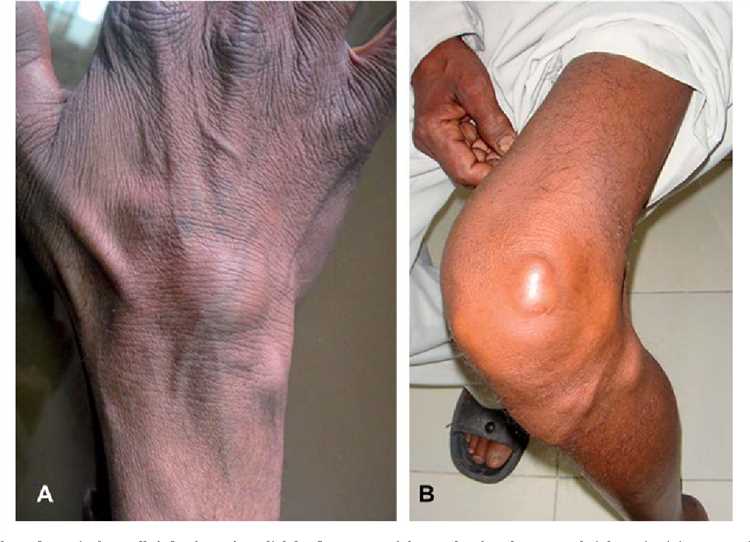 Subcutaneous nodules caused by E. spinifera