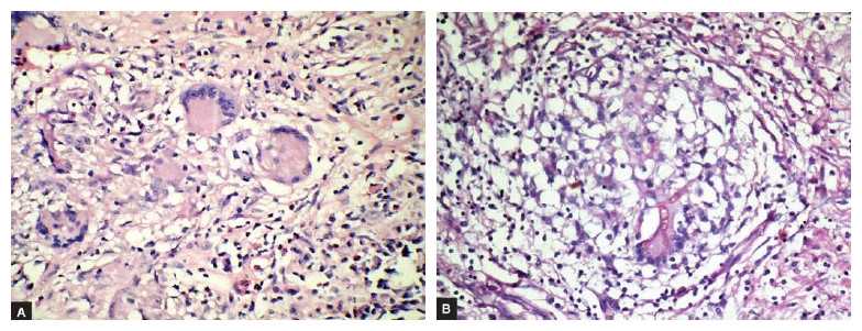 Chronic granulomatous fungal rhinosinusitis with(A) extensive granulomatous process on hematoxylin and eosin stain(X400), (B) fungal hyphae inside giant cells on periodic.