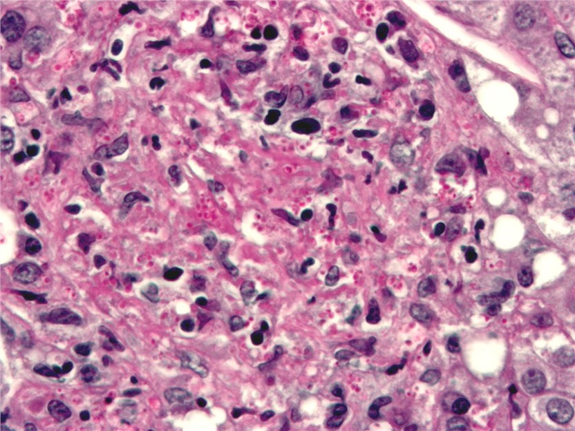 Histoplasma (bright red, small, circular). PAS diastase stain.