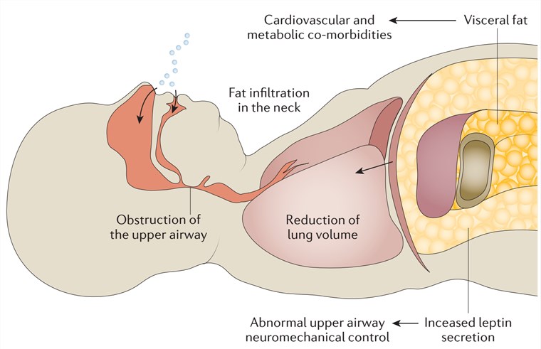 Obesity predisposes to obstructive sleep apnoea syndrome (OSAS).
