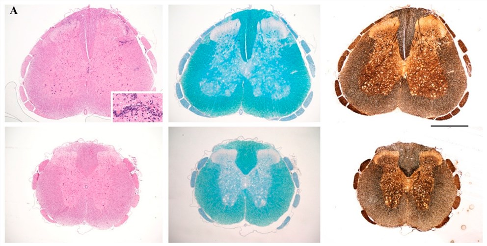 Fig.1 Neuropathological analysis of spinal cord sections taken on day 17 following immunization, from representative non-vaccinated control rats (top) and rats vaccinated. Sections were stained with H&E for inflammation (left panels), Luxol Fast Blue for myelin (central panels), and Bielschowsky's silver stain for axons (right panels). (Emmanouil et al. 2018)