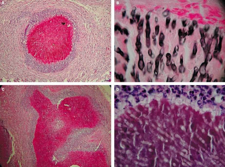 Histological sections of M. mycetomatis eumycetoma in a mammalian host. A and C were stained with PAS staining (200x), B with Grocott methenamine silver stain (400x), and D with hematoxylin and eosin (350x). 