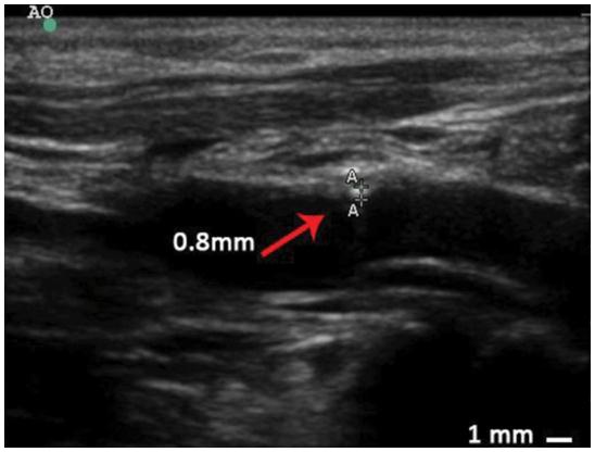 Fig.1 Intima-media thickness measurement of artery walls by ultrasound examination in a rhesus monkey of atherosclerosis (AS). (Zeng, et al., 2015)