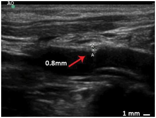 Intima-media thickness measurement of artery walls by ultrasound examination in a rhesus monkey of atherosclerosis (AS).