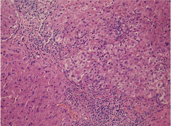 Liver fibrosis in cynomolgus monkeys (H&E staining).