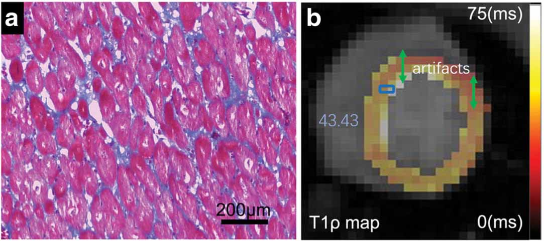 Masson's trichrome staining (a) and fibrosis index map (b) of a rhesus monkey of myocardial fibrosis.