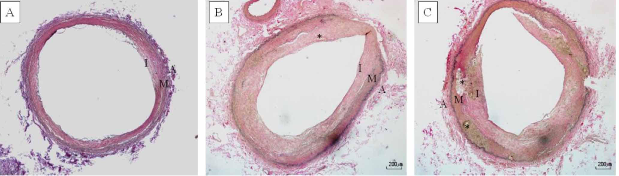 Histology of the common iliac artery stained with Verhoeff van Gieson (VVG) of a monyet of peripheral artery disease (PAD).