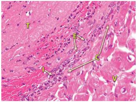Pathology of ventricular free wall (V) attache by intracardiac thrombus (T) in Mustached Tamarins (Saguinus mystax) of intracardiac thrombosis (hematoxylin and eosin staining).