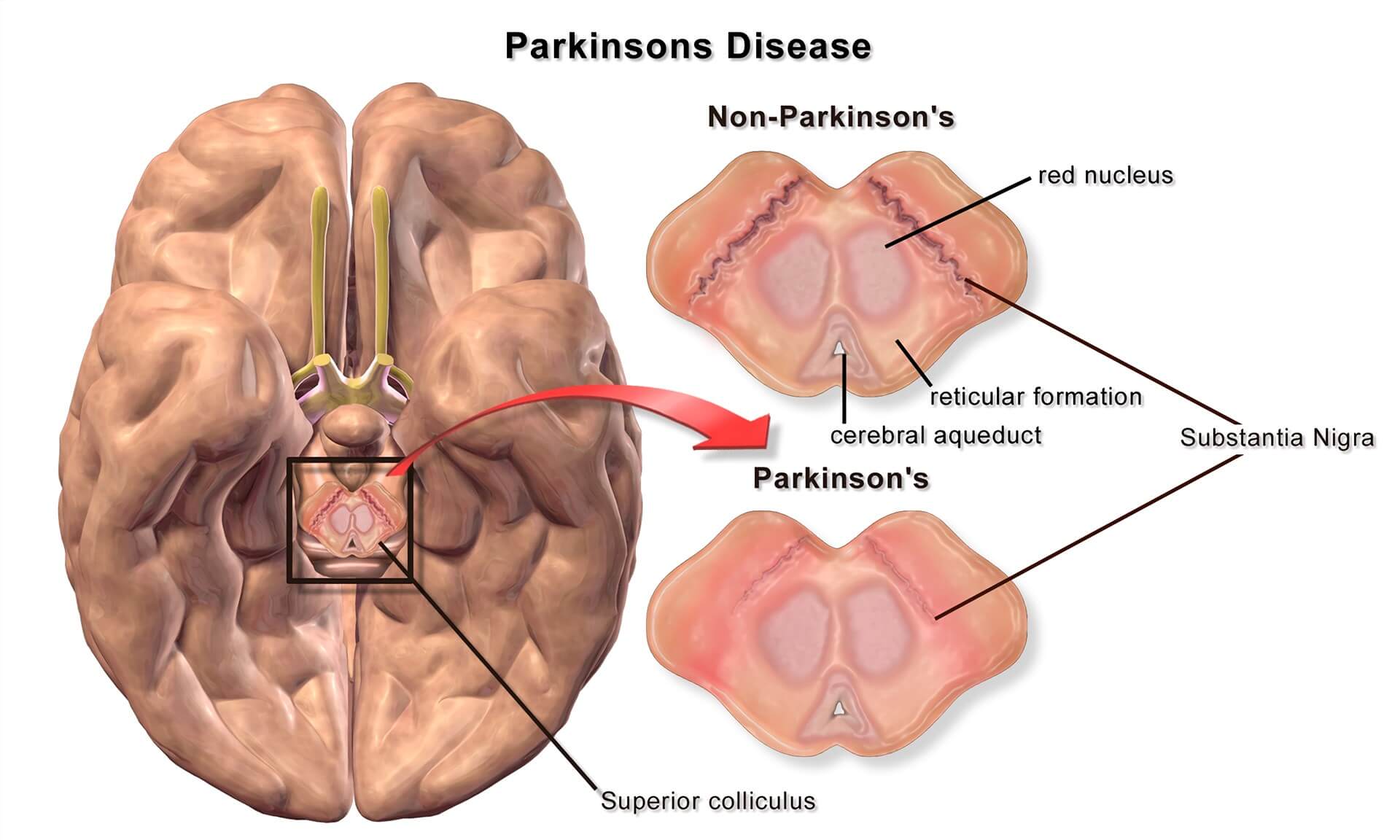 Rodent Parkinson's Disease Models