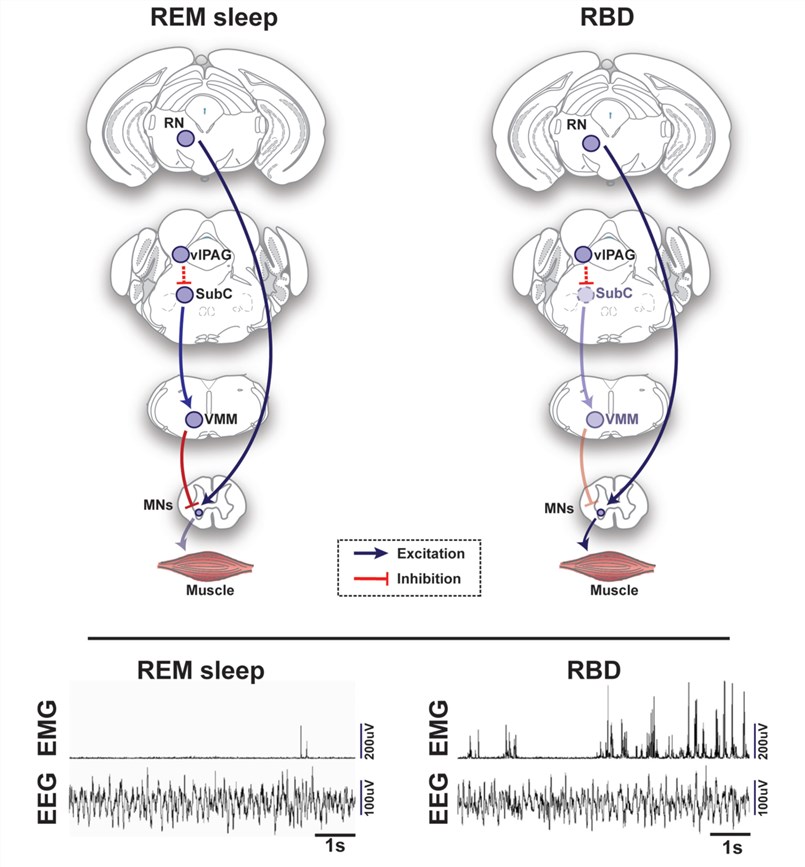Schematic representation of circuits and pathways regulating muscle activity during “normal” rapid eye movement (REM) sleep and REM sleep behavior disorder (RBD) in the rodent brain.