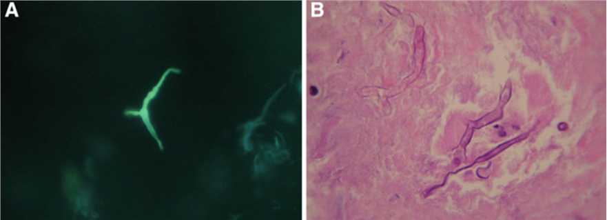 A.Non-septate hyphae of S. vasiformis in rhinosinusitis tissue visualized by Blankophor P fluorescent stain microscopy, (x40). B Histopathology of the rhinosinusitis specimen showing invasion by right-angle branched non-septate fungal hyphae of S. vasiformis, H&E stain (x100).