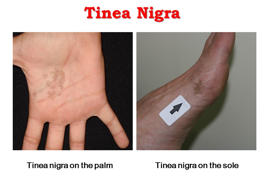 Infection of tinea nigra.