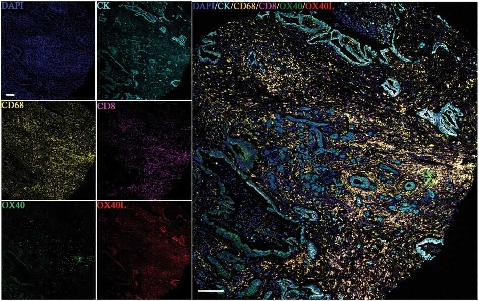 Fig. 1 The multispectral images of CK, DAPI, OX40, OX40L, CD8, and CD68.