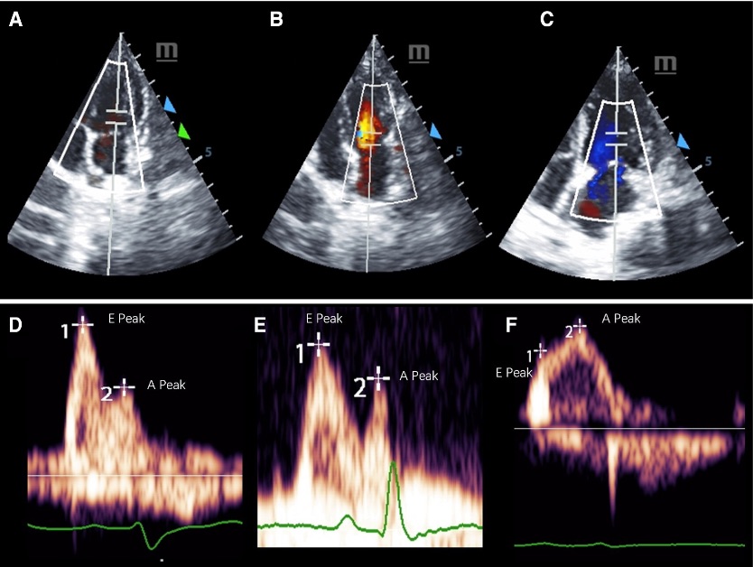 Fig. 1 Pulsed-wave Doppler images of mitral inflow in three groups of cynomolgus monkeys.