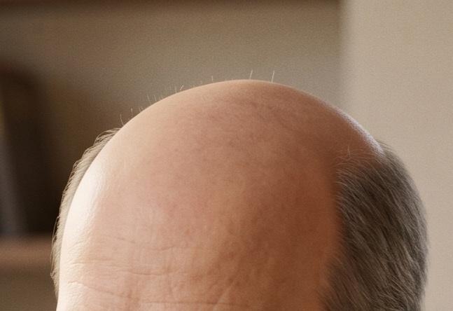 Fig.1 A person with noticeable hair loss. (Creative Biolabs AI)