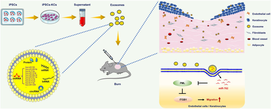 Exosome accelerate burn wound healing. (Bo, et al., 2022) (OA Literature)