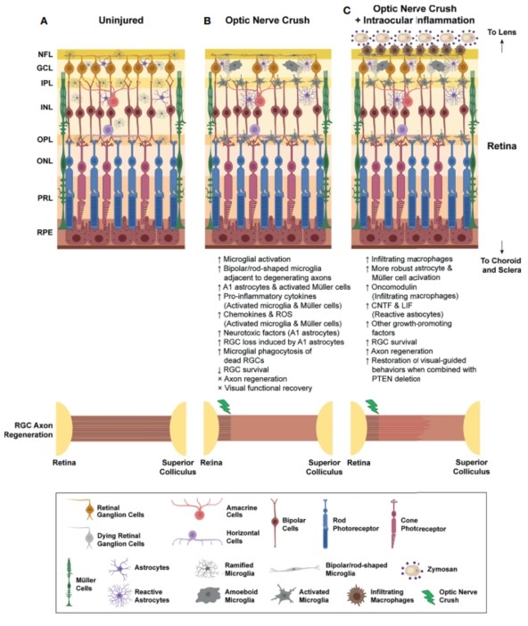 Optic nerve compression Inflammation after injury. (Au, et al., 2022) (OA Literature)