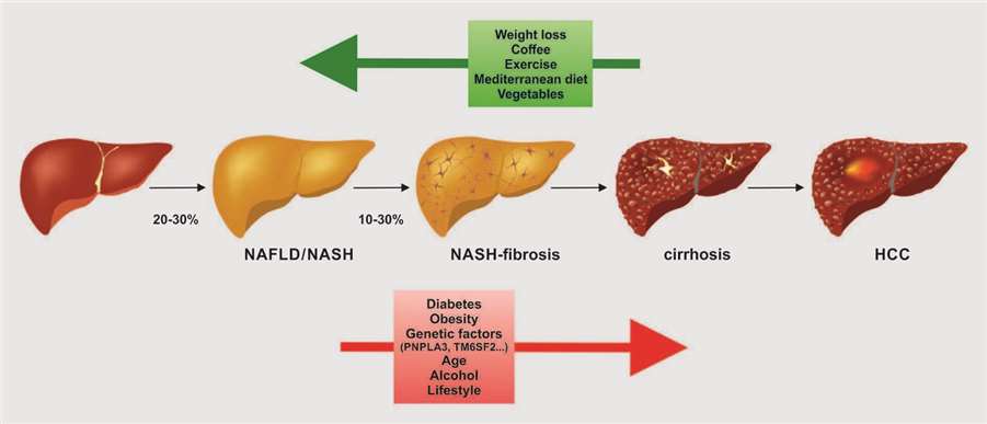 Fig.1 Clinical conditions from normal liver to NAFLD, NASH, cirrhosis, and HCC.