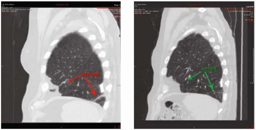Representative computed tomography images before and after 1 month of P-MSC-Exo-MAPPS treatment of COPD patients.