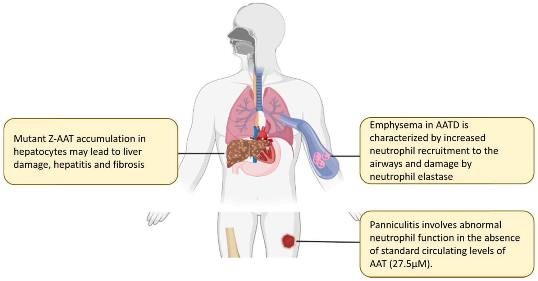 AAT deficiency leads to a large influx of neutrophils into the airways. Increased serine protease release and uninhibited NE activity can cause lung parenchymal damage, ultimately resulting in emphysema and COPD. (OA Literature)