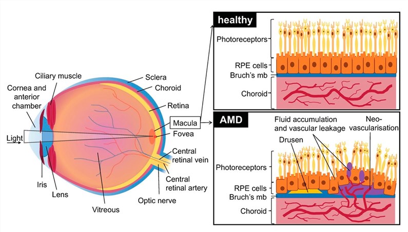 Schematic diagram of healthy retinal, choroidal and retinal pigment epithelial (RPE) cells, as well as the effects of age-related macular degeneration (AMD). (OA Literature)