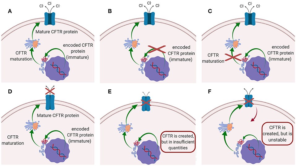 Schematic diagram of CFTR mutations causing CF disease: (A) CFTR is functioning normally (without mutations); (B) Class I and Class VII mutations; (C) Class II mutation; (D) Class III and Class IV mutations; (E) Class V mutation; (F) Class VI mutation. (OA Literature)