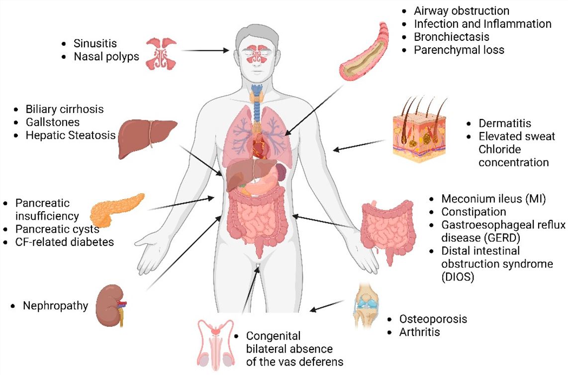 The manifestations of cystic fibrosis in different organs, including the ovaries, liver, kidneys and skin. (OA Literature)