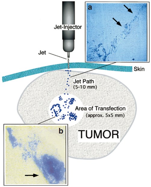 Schematic representation of jet injection pattern in the tumor tissue.