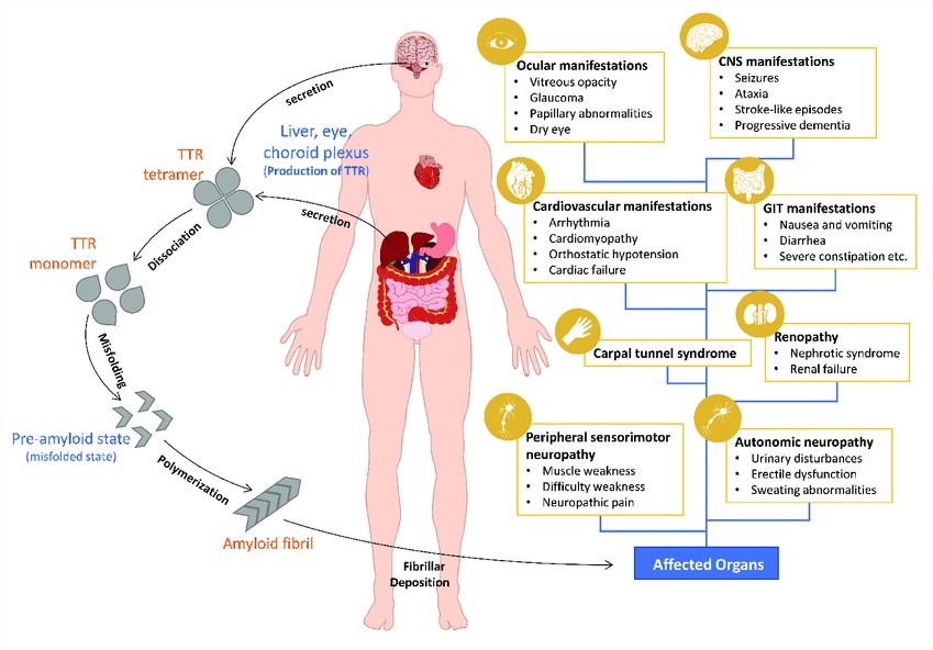 Pathogenesis and clinical manifestations of ATTR amyloidosis.