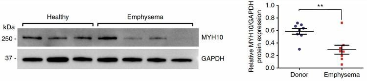 Expression of MYH10 is low in lung tissues from emphysema patients than from healthy controls