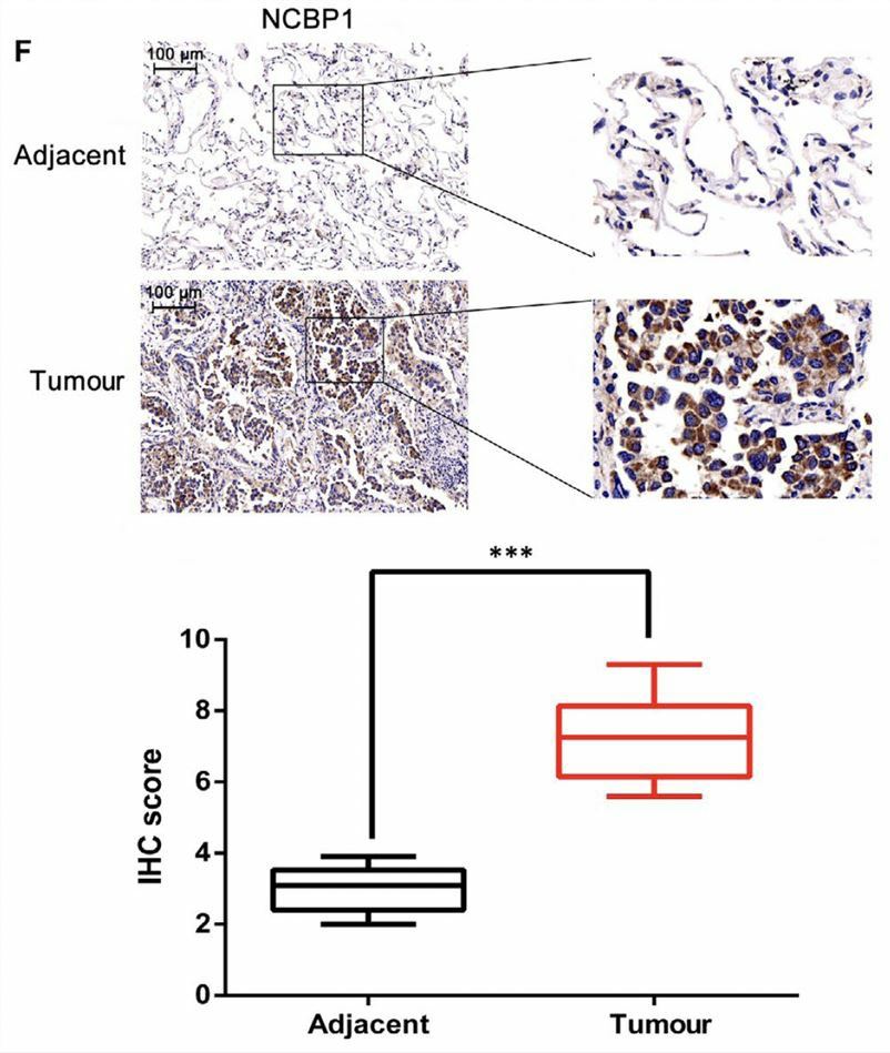 High expression of NCBP1 exists in lung cancer tissue than in adjacent tissue