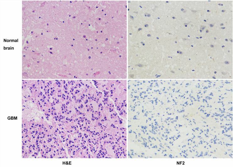 Downregulated NF2 is observed in GB tissue compared with healthy brains