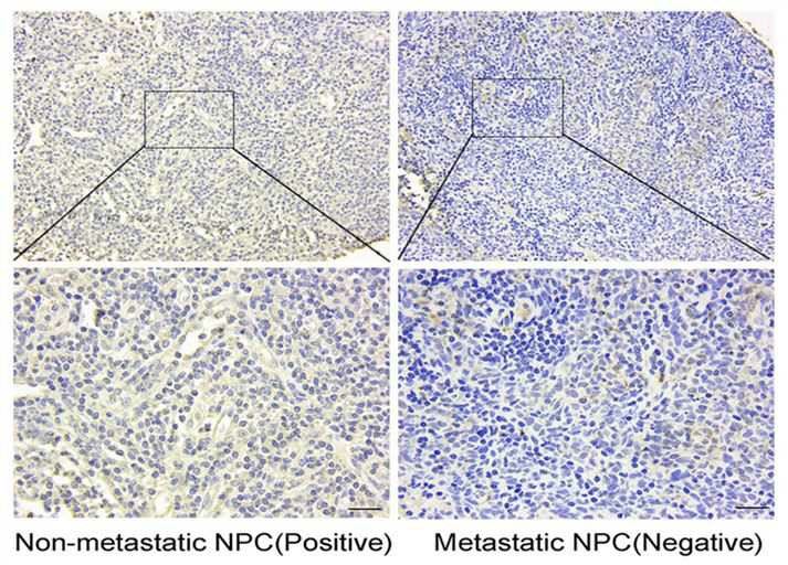 Lower expression of NOTCH2 is observed in non-metastatic NPC