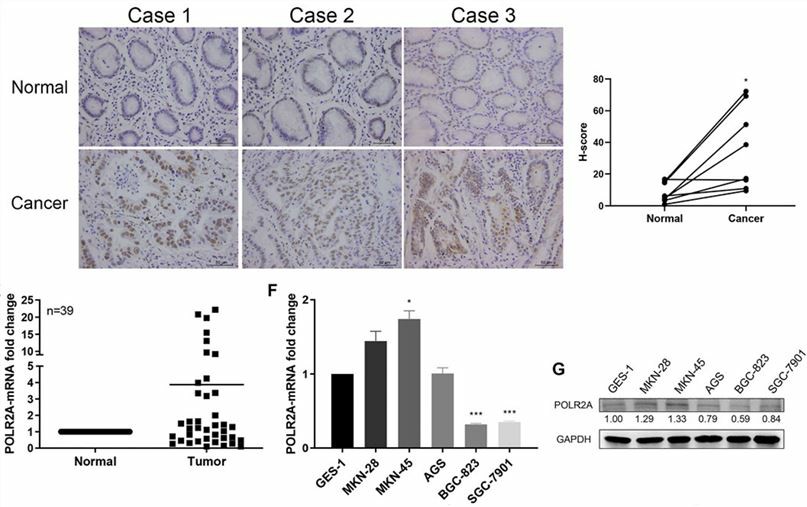 POLR2A was highly expressed in GC tissues.