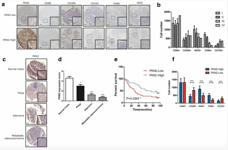 Overexpression of PKN2 is associated with better clinical outcome and high M1 content in human colon cancer.